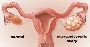 Polycystic Ovary